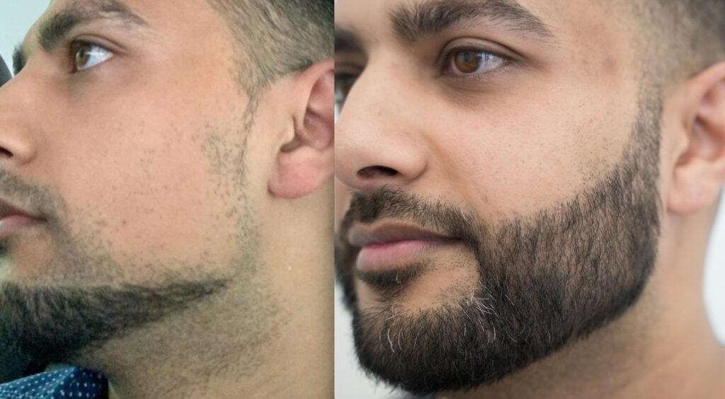 A full, well-shaped beard has become a defining feature for many men across the UK. But patchy growth, scarring or genetics can make achieving that look frustrating or impossible.